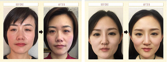 整骨小颜培训_骨雕