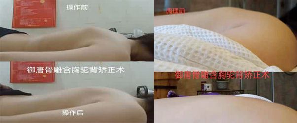 含胸驼背矫正_御唐整骨